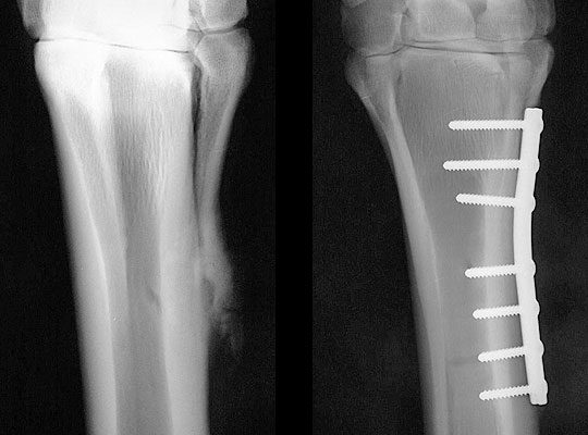 Splint bone screws