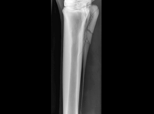 splint broken